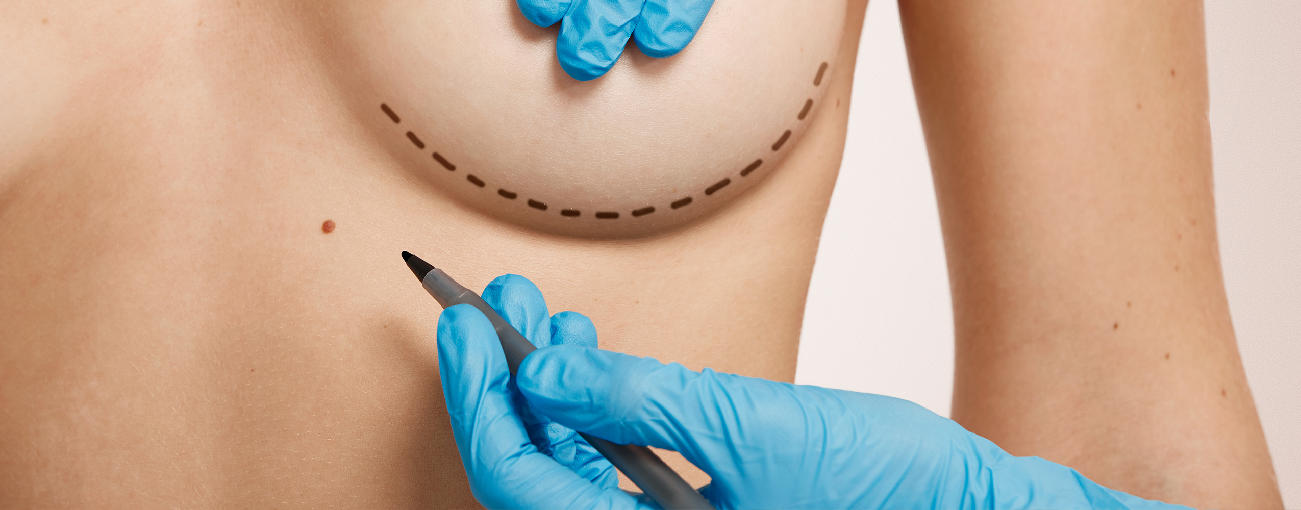 Aumento de mamas con implantes – Una decisión personal y poderosa